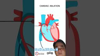 Cardiac Ablation [upl. by Aticnemrac]