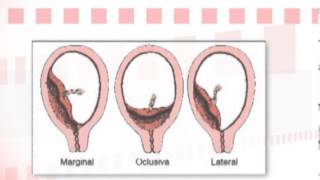 Dr Ignacio Pérez Tomasone ¿Qué es la placenta previa [upl. by Courtnay]