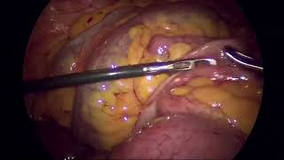 Laparoscopic management of Adhesive Band small bowel obstruction [upl. by Ennyroc808]