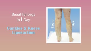 Cankles amp Knees Liposuction  Lipedema Legs  Expert Dr Thomas Su [upl. by Nahshu380]