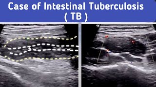 Ultrasound Intestinal Tuberculosis TB [upl. by Docilla]