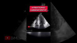 Hypertrophic Cardiomyopathy Echocardiography showing SAM of AML Echocardiography [upl. by Aivyls8]