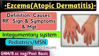 Eczema  Atopic Dermatitis lecture in Hindi [upl. by Ecaj]