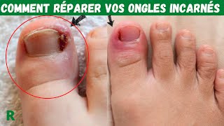 Comment réparer les Ongles incarnés rapidement et facilement [upl. by Prosper]