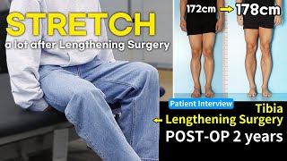 Stretching is the KEY after 🦵 Limb Lengthening Surgery  PRECICE Patients 2 Years PostOp Interview [upl. by Ludvig]