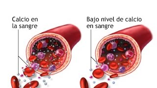 HIPOCALCEMIA  BAJO NIVEL DE POTASIO EN SANGRE [upl. by Iek]