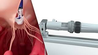 PASCAL Precision System – Implantation of the device in the mitral and tricuspid valves  Animation [upl. by Wendeline]