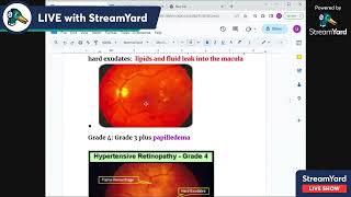 2 Hypertensive retinopathy stages NEW [upl. by Rheba860]