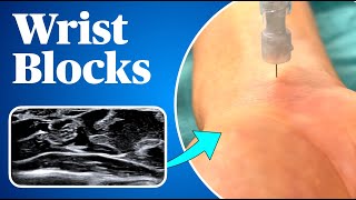 Wrist Blocks Landmark AND ultrasound guided approaches [upl. by Ji]