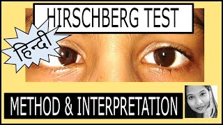 हिन्दी Hirschberg Test कैसे करें  Squint Examination [upl. by Dareece348]