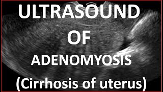 Ultrasound of Adenomyosis [upl. by Neik]