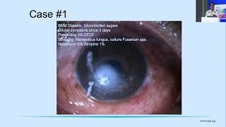 AIOCMTC2 2023 GP68 topic Dr Aravind Roy Intrastromal and Intracameral injection of Antimicrobials [upl. by Pembrook195]