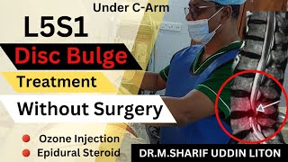 L5S1 Disc Bulge Treatment without Surgery L5s1 Transforamianal Steroid Injection  Ozone Therapy [upl. by Trainer]