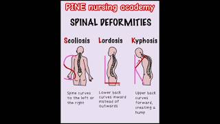 Spinal deformity kyphosis scoliosis lordosis bone spine medical aiims [upl. by Onavlis286]