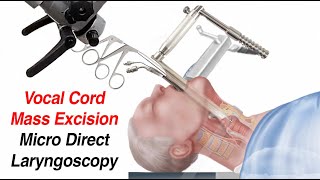 Vocal Cord Surgery Mass Excision  Micro Direct Laryngoscopy [upl. by Felty262]