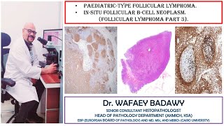 PAEDIATRIC TYPE FOLLICULAR LYMPHOMA AND IN SITU FOLLICULAR B CELL NEOPLASM BY DR WAFAEY BADAWY [upl. by Nothgiel]