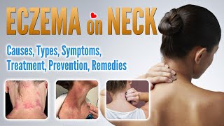 Eczema on neck Causes Types Treatment Prevention and Natural Home Remedies  Neck Dermatitis [upl. by Dysart]