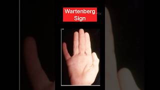 Wartenberg sign ytshorts neurology health [upl. by Meletius]