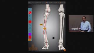 Osteotomy Rules [upl. by Ykcul]