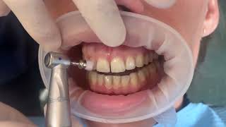 CÓMO FUNCIONAN LOS BRACKETS  Movimiento Dental [upl. by Bushey3]