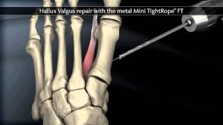 New Bunion Surgery Colorado Foot Institute [upl. by Nahshu]