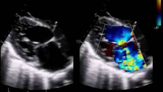 Perforated Mitral Valve [upl. by Scrivens918]