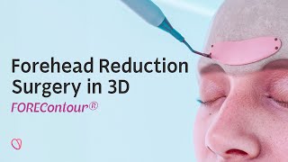 FOREContour® — Forehead Reduction Surgery in 3D [upl. by Lanny424]