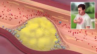 Atherosclerosis Pathophysiology USMLE [upl. by Shauna]