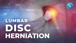 What is Lumbar Disc Herniation  Herniated Disc [upl. by Loseff249]