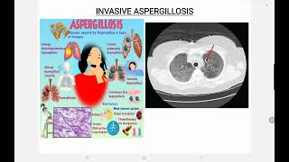 Invasive Aspergillosis [upl. by Edelsten858]