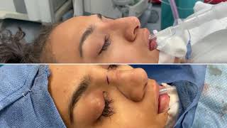 Watch This Rhinoplasty Transformation by Houston Nose Specialist Dr Michel Siegel [upl. by Camel]