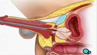 TURP Transurethral Resection Prostate penis Surgery  PreOp® Patient Education [upl. by Sidney]