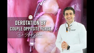 orthodontic derotation of rotated premolar by amr asker [upl. by Ardnekal]