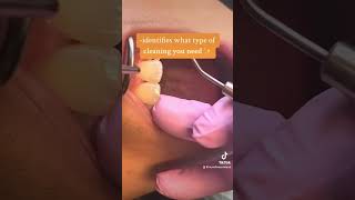 What is periodontal charting dentist dentistasdeconfianza dentista [upl. by Tatman355]