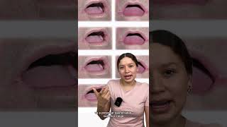 Queilitis angular  Odontologia con cri dentista estomatologia [upl. by Adrienne]