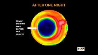 HOW DOES OVERNIGHT VISION CORRECTION WORK [upl. by Marci]