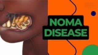 Understanding Noma Its Causes Symptoms and Treatment  A Comprehensive Health Education Guide [upl. by Ennaxxor488]