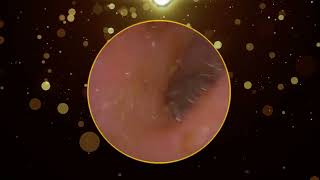 Blocked Ear Wax Removal [upl. by Cecilia]