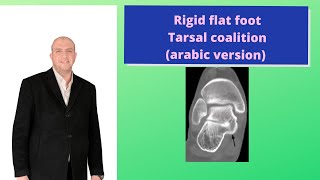 Rigid flat foot  Tarsal coalition arabic version [upl. by Sinai781]