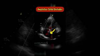 Amplatzer Septal occluder as seen on Echocardiogram echocardiography heart asd [upl. by Kellene]