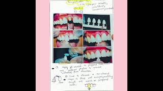 Temporization in FPD Provisional restoration LAQ NOTES [upl. by Tewfik]