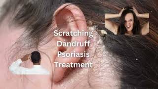 Effective Homeopathic Treatment for Scratching Dandruff amp Psoriasis  Natural Relief Solutions [upl. by Urien573]