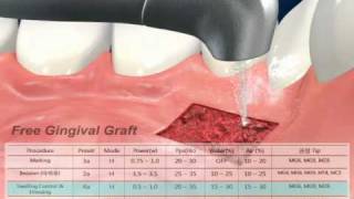 Waterlase MD Laser Free Gingival Graftwmv [upl. by Suicul226]