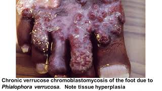 Lecture 9  Chromomycosis and Mycetoma [upl. by Hoagland]