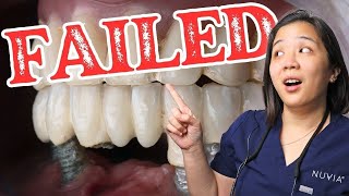 Doctor Reveals Top 3 Reasons Dental Implants Fail [upl. by Archibaldo]