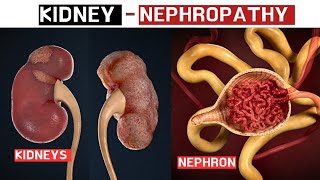 Nephropathy kidney [upl. by Parthena]