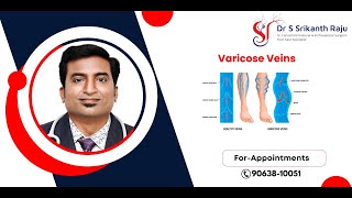 Varicose Veins  All you need to Know  DrSrikanth Raju  Vascular Surgeon  Hyderabad [upl. by Rramel215]