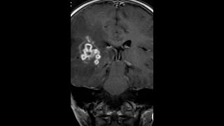 5 casesneuroradiology cnsradiological anatomy tutorials quiz basicsradiopediafrcrradiant [upl. by Htebezile604]