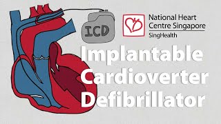 What is an Implantable CardioverterDefibrillator ICD  What to Expect [upl. by Margit]