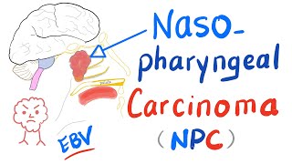 Nasopharyngeal Carcinoma NPC Location Risk Factors Clinical Picture Diagnosisamp Management [upl. by Enait]